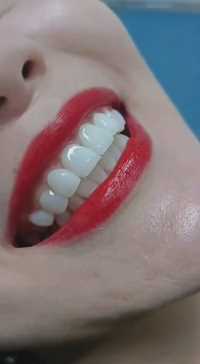 【黄牙 大牙缝】修复完成
有一种美叫作“笑容杀”
当你露牙微笑的那一刻
整个世界都是buling~buling✨