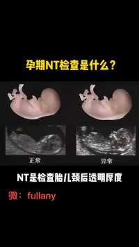 孕期NT的检查，在11周-13周之间检查，超过时间不能查。